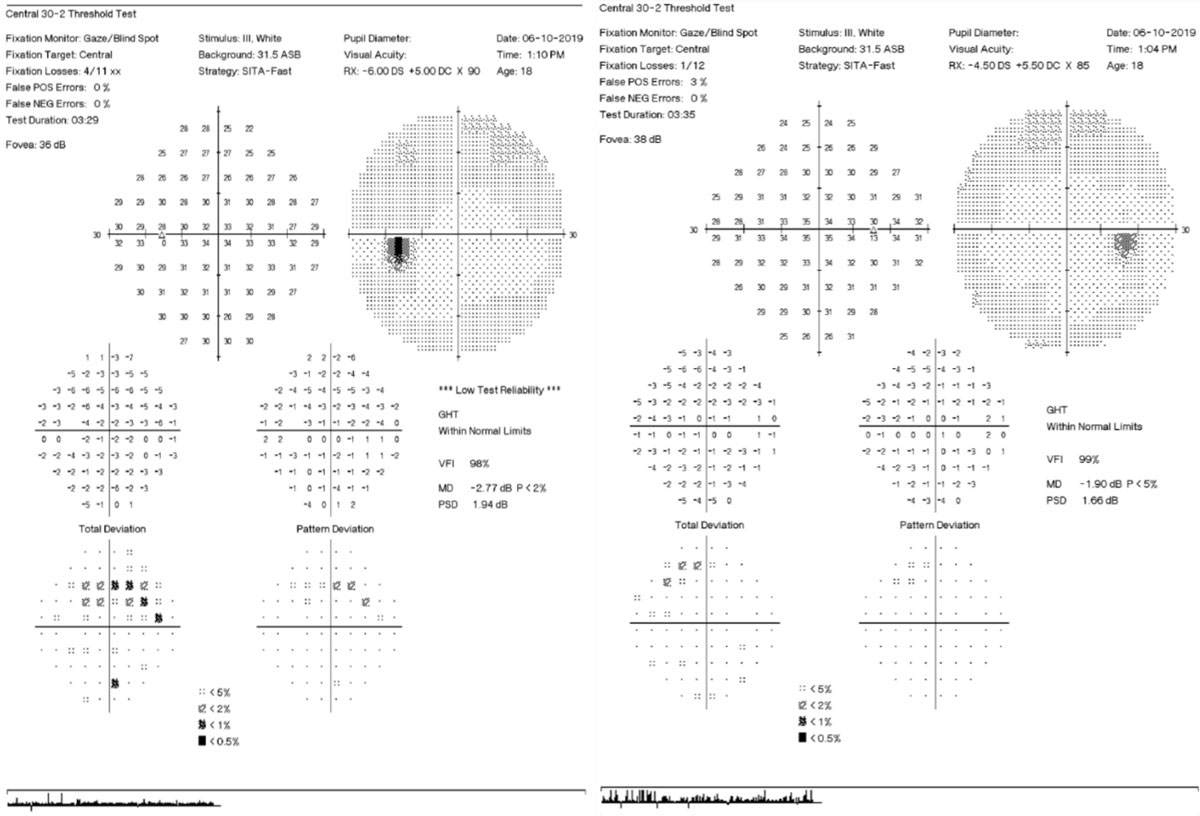 Figs. 2-4. Above, 30-2 visual field testing shows scattered superior arcuate defect points in both eyes, but more so in the left. 