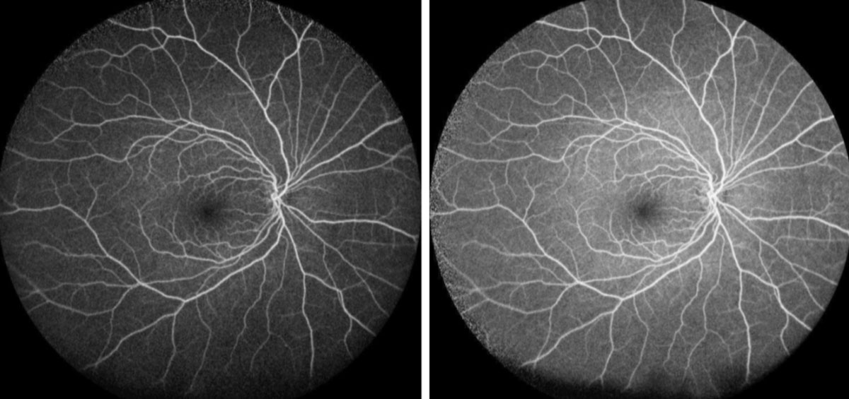 Fig. 3. Her right eye is normal on FA. 