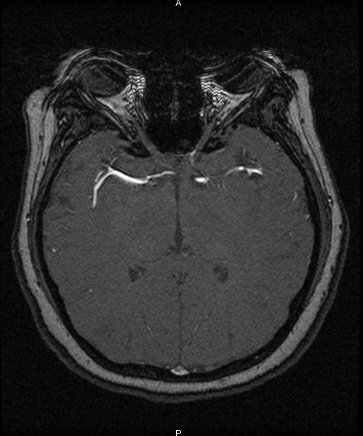 Fig. 6. An MRI exposes a 1.4mm to 1.5mm saccular aneurysm of the anterior communicating artery.