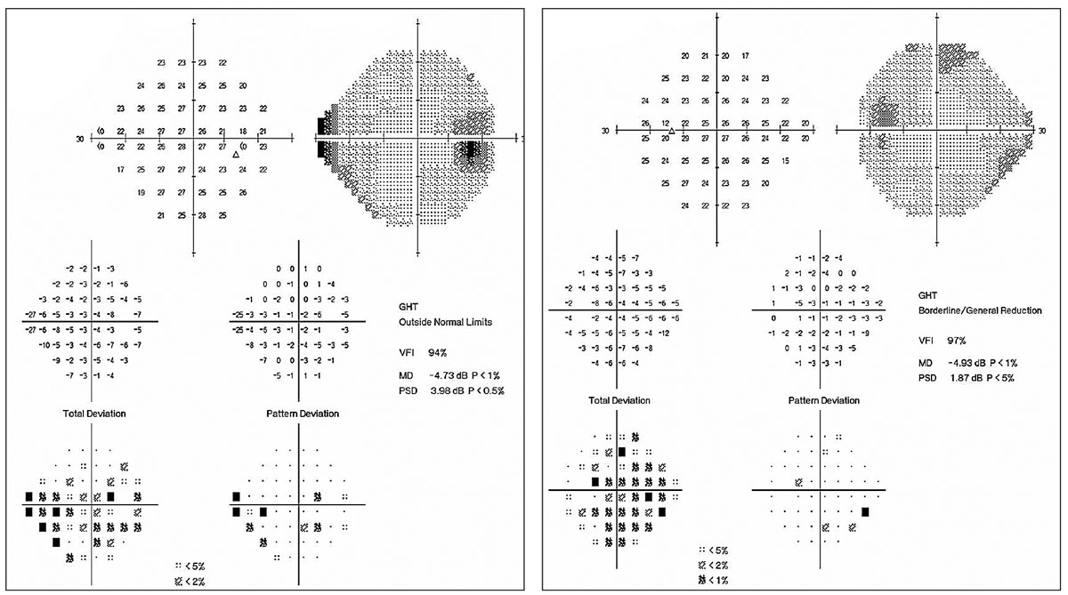 Fig. 1. This 92-year-old white female is currently taking latanoprost OU at bedtime. She has a maximum IOP of 22mm Hg with an IOP on exam of 18mm Hg OU. Corneal thicknesses are 523µm OD and 520µm OS. The patient’s testing shows only mild visual field loss. Given her age and clinical picture, it is unlikely she will experience real functional impairment in her lifetime. A mild (even if confirmed) progression of RNFL loss might not be an indication to escalate therapy.