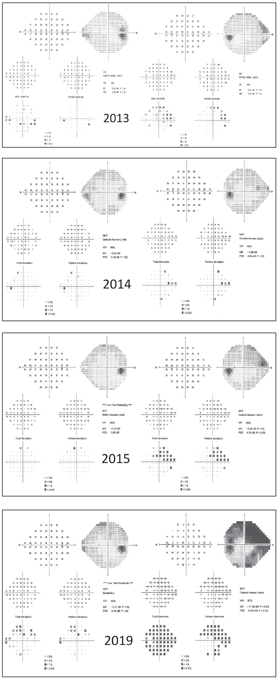 Fig. 2. This 59-year-old male was lost to follow up for four years, during which time he discontinued his drops. His visual fields demonstrate progression. Patients such as this might benefit from surgical intervention rather than topical therapy. 