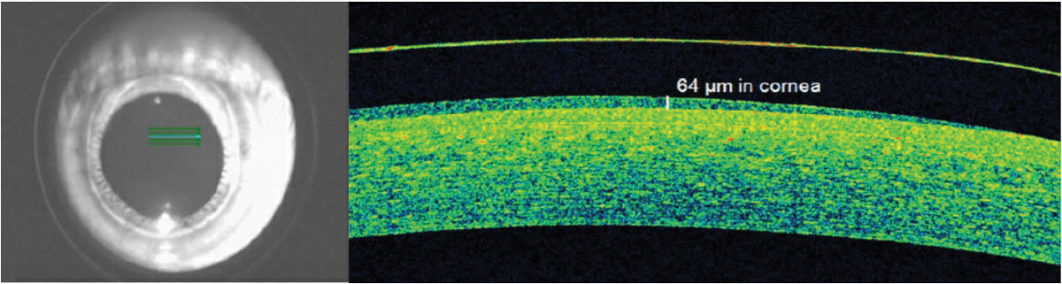 Fig. 3. OCT identified acceptable apical hybrid lens clearance on a keratoconus patient when slit lamp estimates were variable.