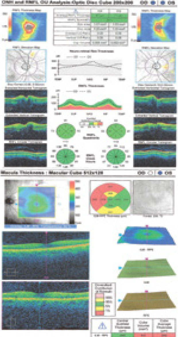 RNFL thickness findings on OCT.