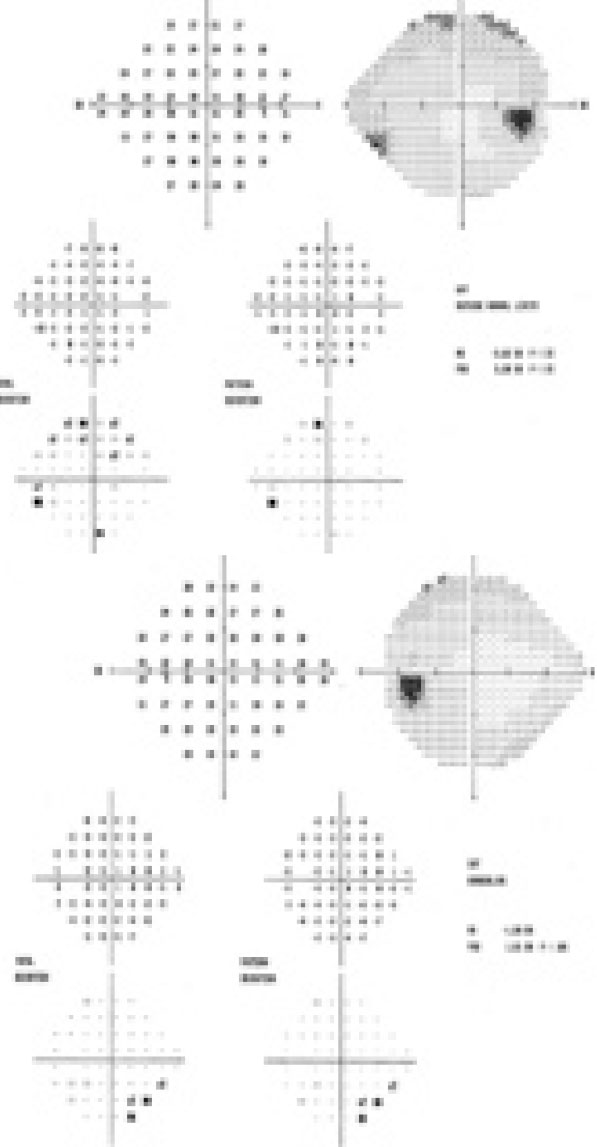 Visual field testing results.