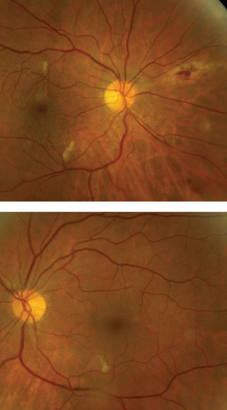 Note the peripheral retinal changes nasally in the right eye (above). Can you identify the finding in the posterior poles of both eyes?