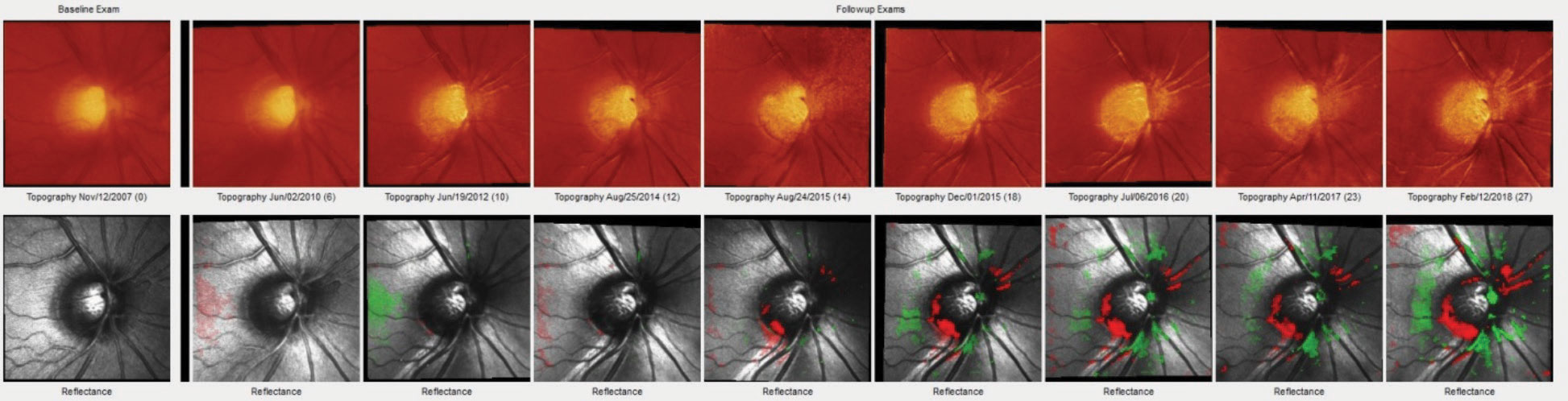 Heidelberg Retina Tomograph-3 imaging shows a distinct change in the inferotemporal neuroretinal rim of a 57-year-old patient. This series shows this change progress over the course of 11 years. Monitoring this kind of change over time is elemental to caring for glaucoma patients and suspects.