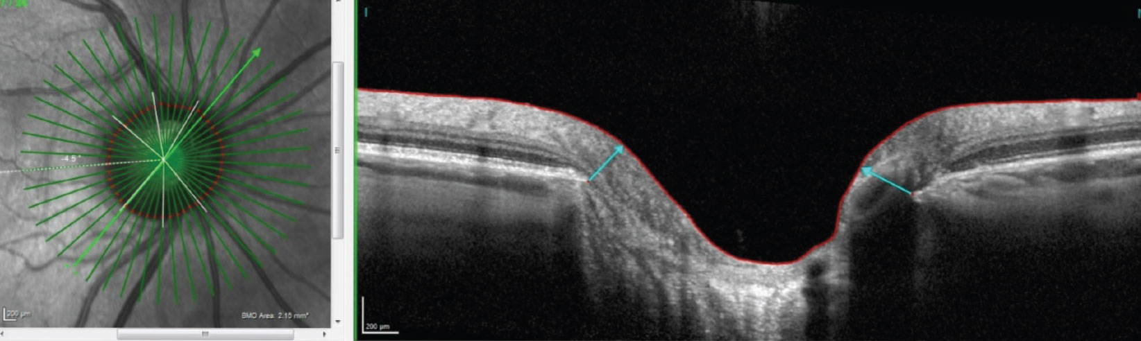 OCT images, such as this radial OCT of a steep nasal margin and sloping inferotemporal margin, offer deep insight into glaucoma patients.