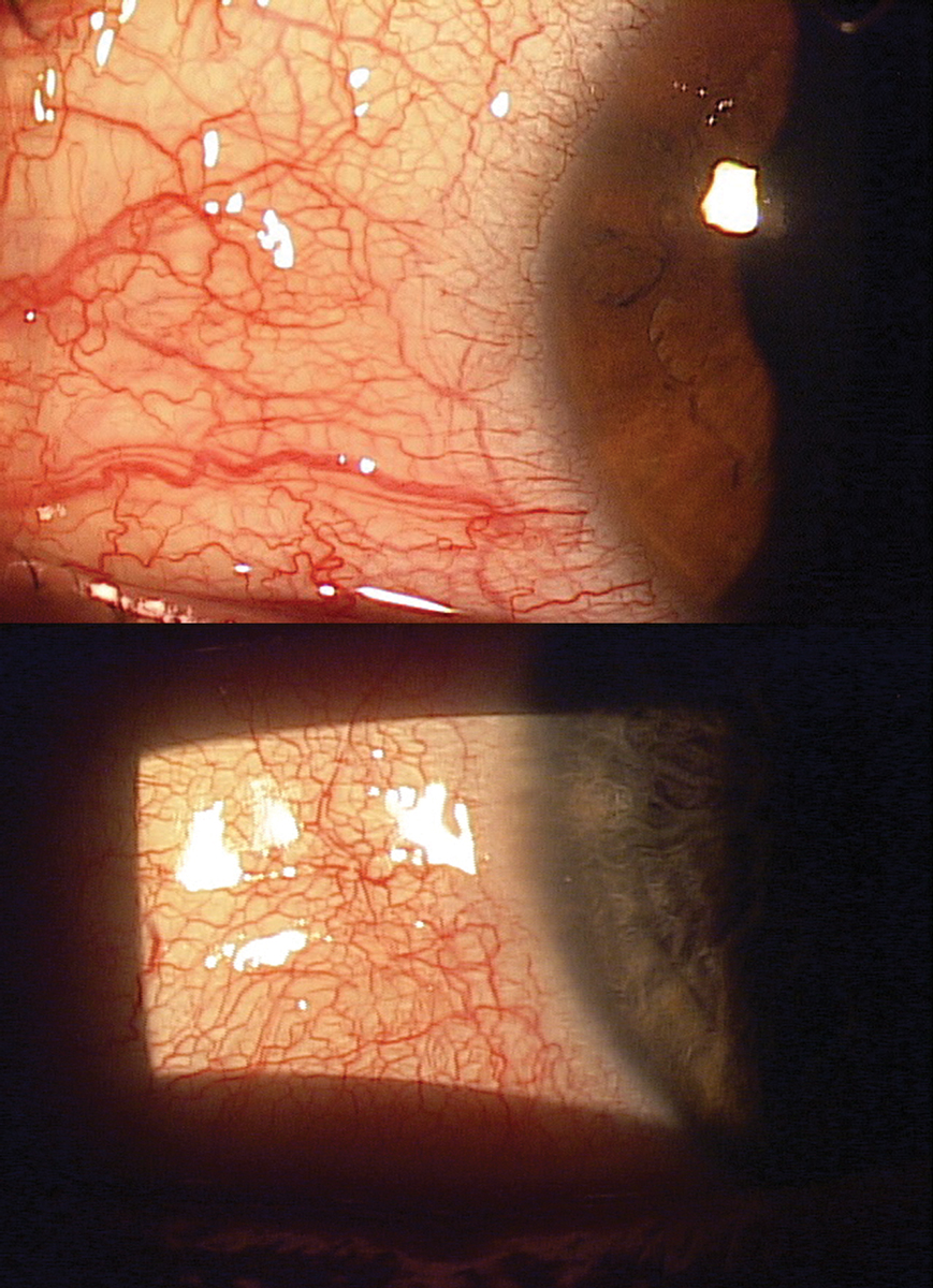 These images show different patients with a common disease—viral conjunctivitis. The novel coronavirus currently threatening the planet can present quite similarly to these patients.