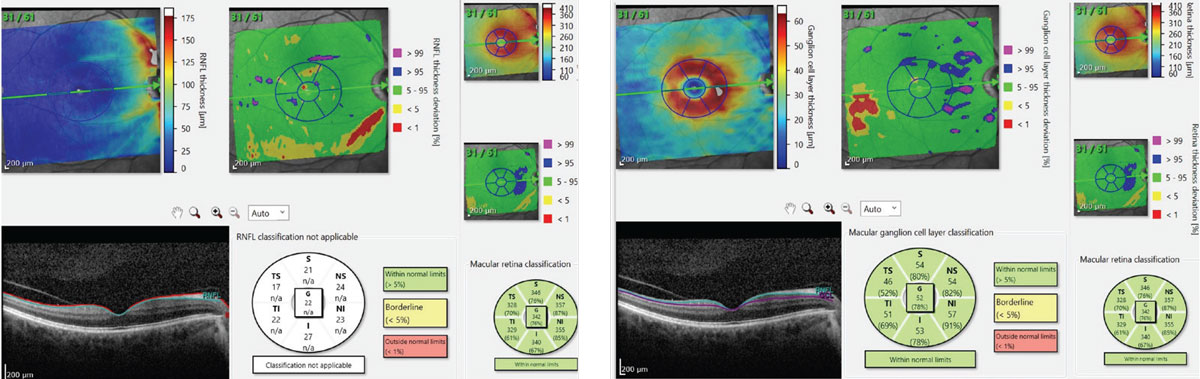 Figs. 5 and 6. At left, this scan shows our patient’s RNFL defect in red in the center top image. At right, the top center image, in red, shows the patient’s GCL deviation map. Note that the location of these ganglion cell bodies is consistent with the location of their axons as seen in the left image. 