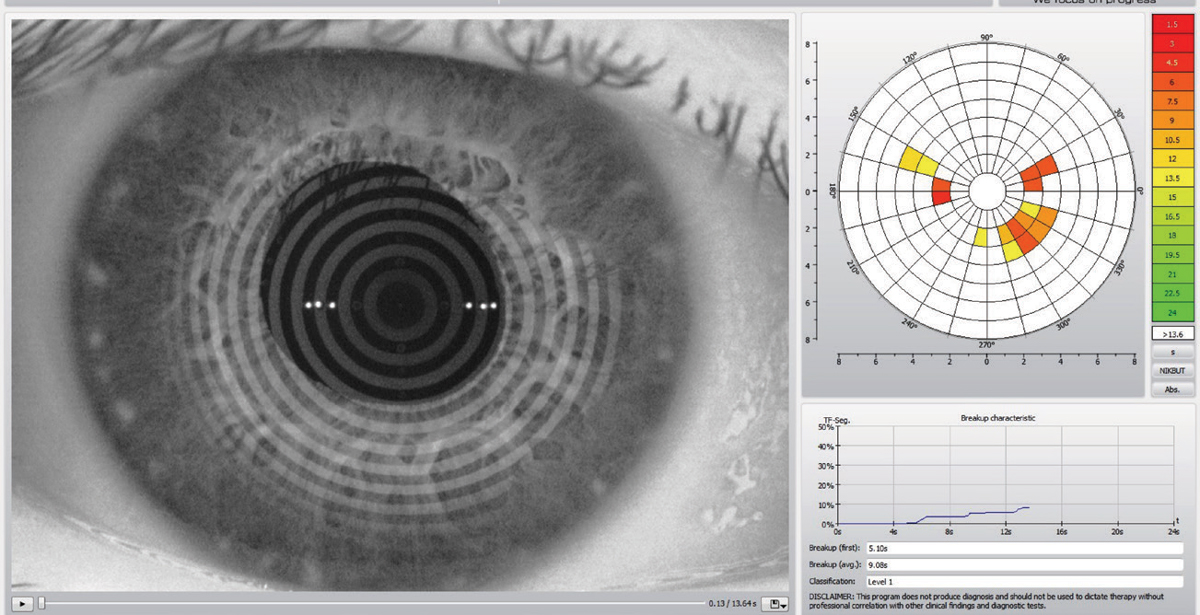 This Keratograph 5M (Oculus) images is can help establish a patient’s tear break-up time, which can help prepare them for surgery.