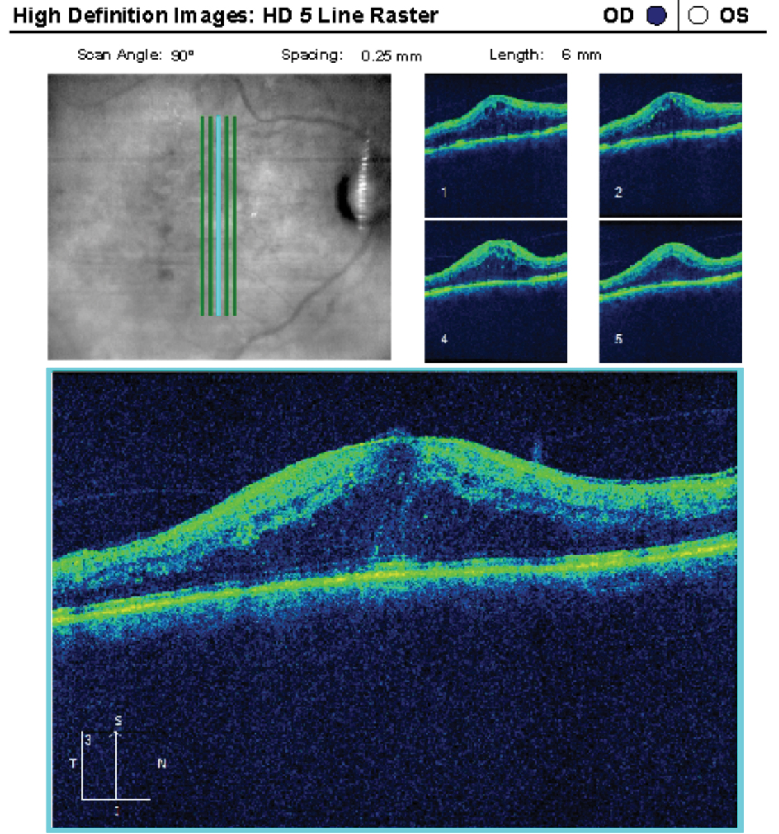 This 64-year-old patient had a history of poorly controlled insulin-dependent diabetes with significant DME in the right eye. She underwent two aflibercept injections previously. Some research shows statins may also reduce VEGF.