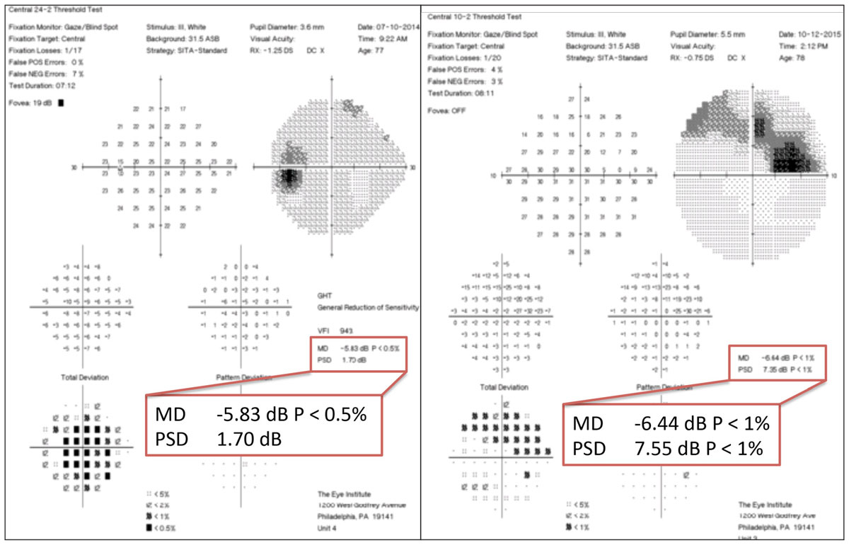 At left, the 24-2 VF shows one centrally depressed point, which manifests as a larger defect on the 10-2 VF, at right, due to higher resolution and more central field. The MDs are similar but slightly worse on the 10-2 VF due to larger defect detected with higher resolution.