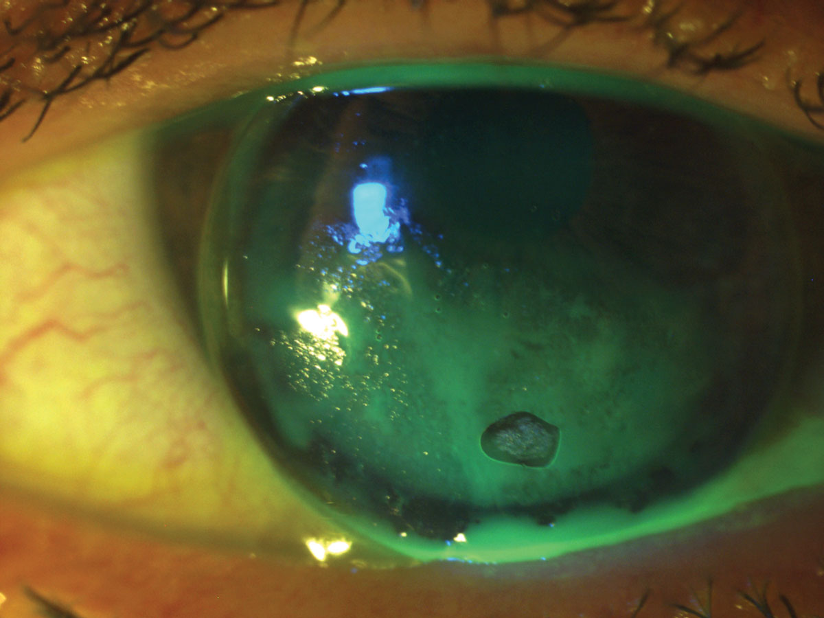 Fig. 4. In this case, lip balm was inadvertently transferred to the lens, resulting in poor GP lens wetting. 