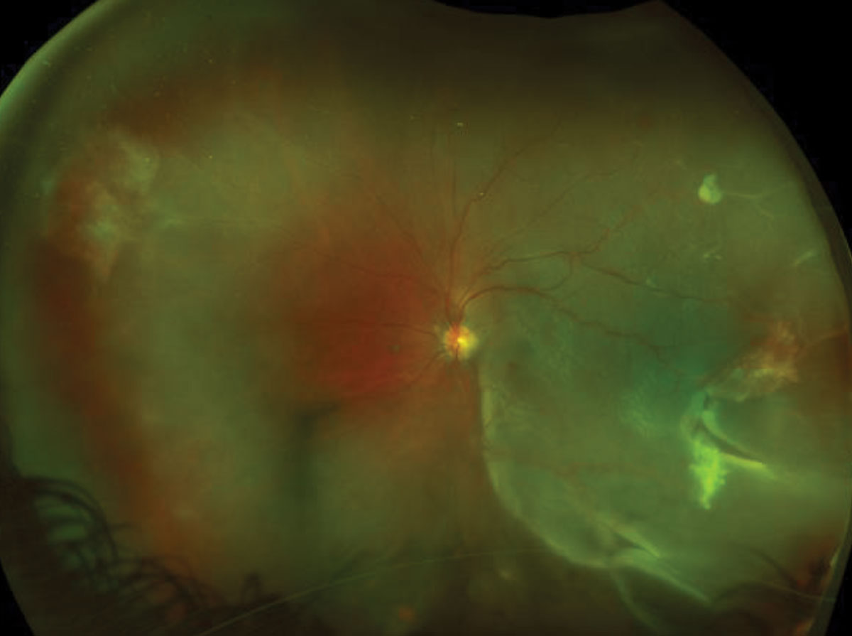 Fig. 1. These ultra-widefield fundus photos show our young patient’s right (at top) and left eyes. What do you notice that can explain his blurry vision? 