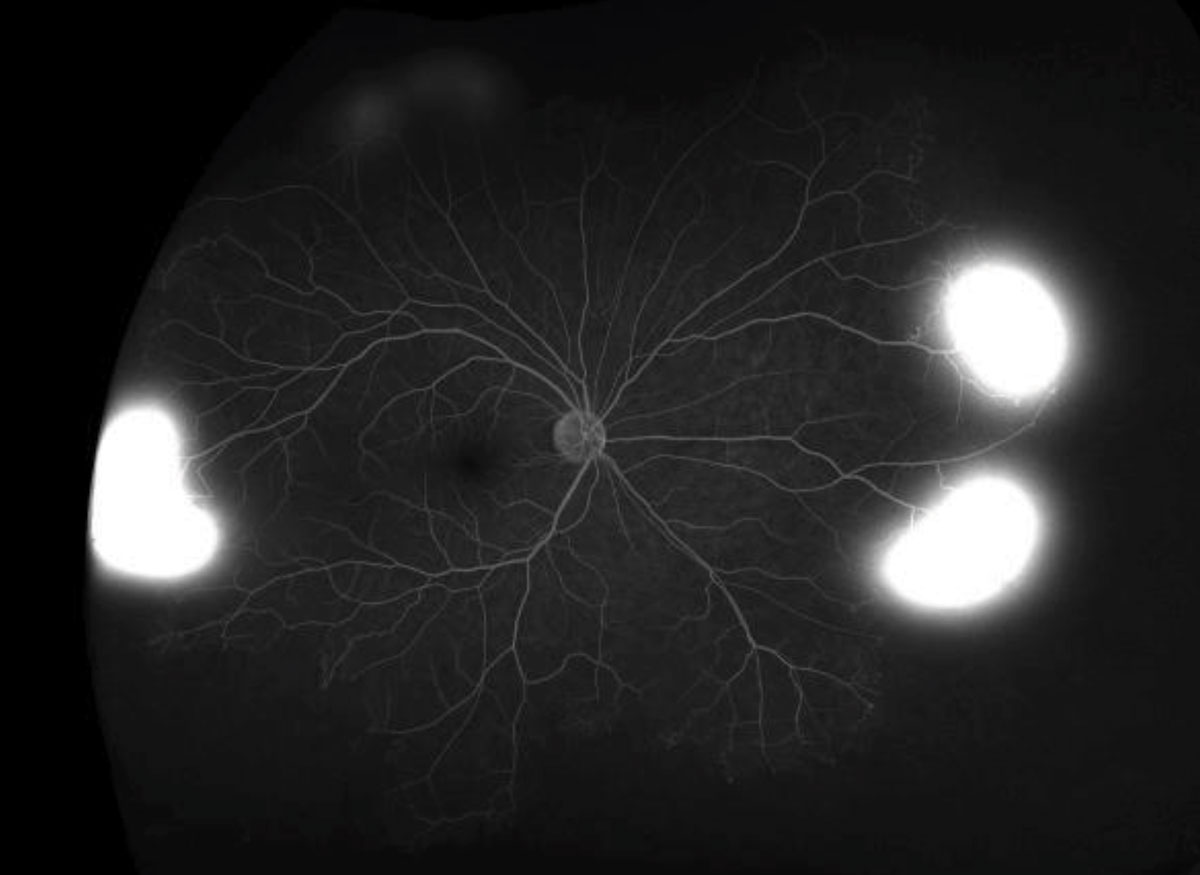 Fig. 3. These ultra-widefield FA images depict the late phase in both eyes. 