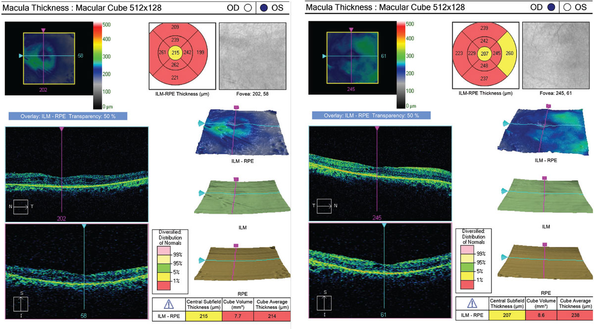 Fig. 2. OCT is sensitive at identifying CME responsible for central vision loss. Close inspection of the EZ can also help identify structural abnormalities suggestive of RP.