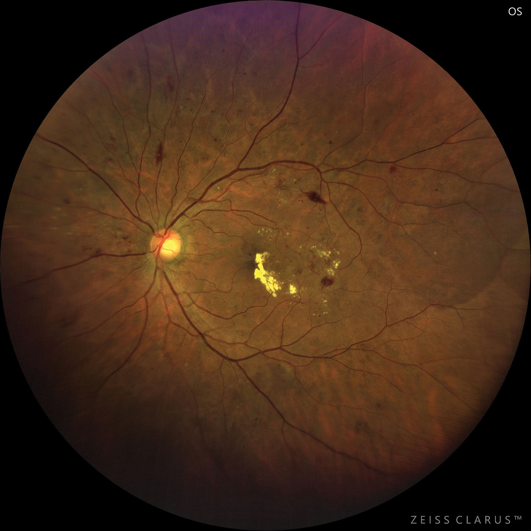 This patient with moderate to severe NPDR developed CSME.