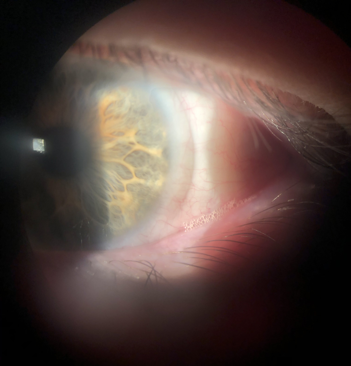 Patients with ocular surface compromise often experience visual fluctuations that reduce the quality of multifocal contact lens wear.