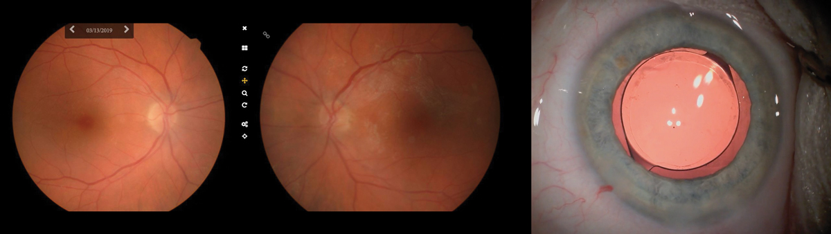 Left & middle: Fundus photos taken in the office of a 73-year-old woman sent for cataract surgery. These photos were sent along with the patient’s chart, helping the surgeon to visualize the underlying RPE mottling and surrounding atrophy most dense superior nasal to the fovea OD and a widespread epiretinal membrane OS. Right: We recommended a monofocal implant, seen here with retroillumination, as the retinal pathology would cause too much variability and thus undermine the success of a multifocal IOL.