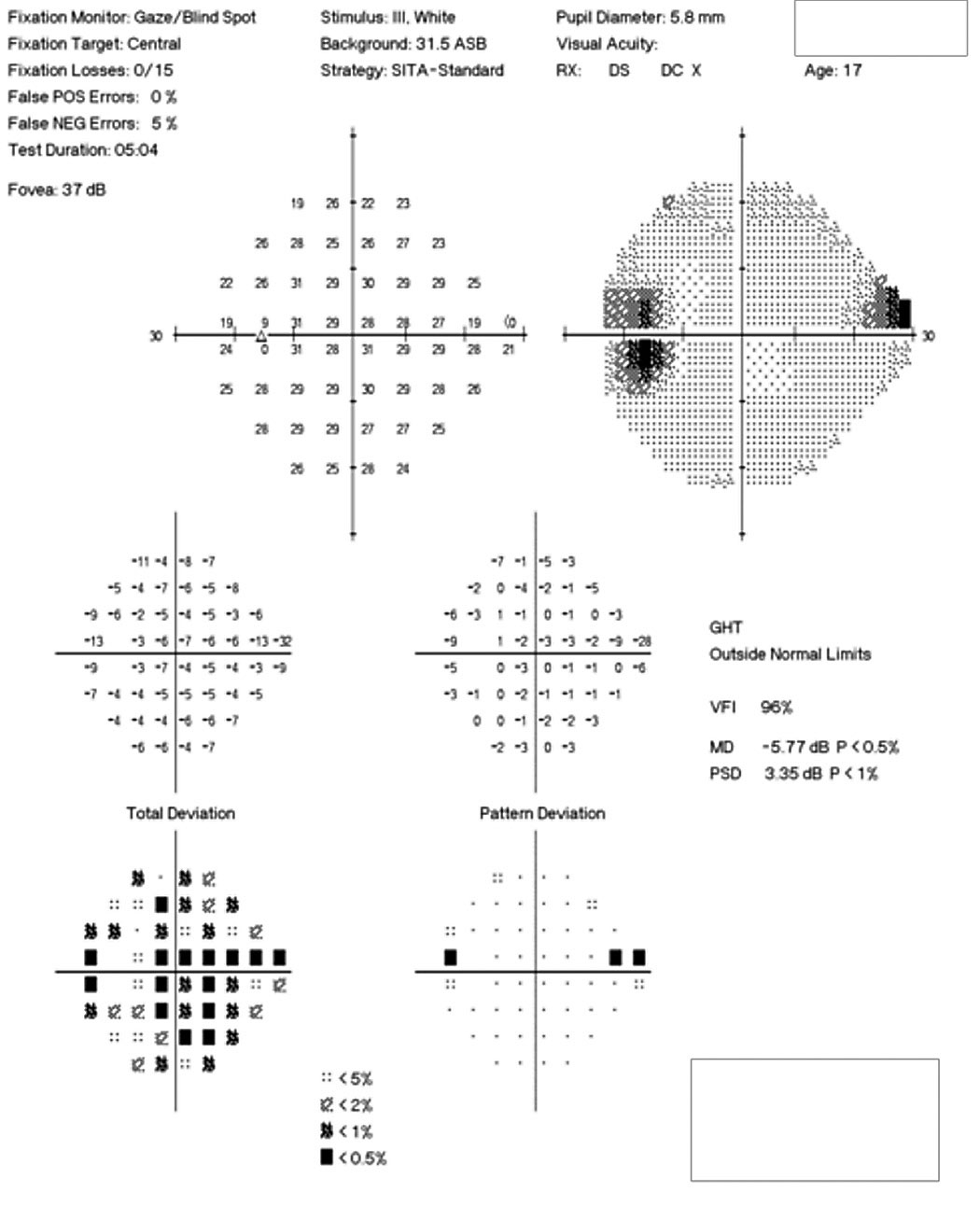 The patient’s 24-2 visual field OS demonstrates a small superior nasal step and enlarged blind spot.