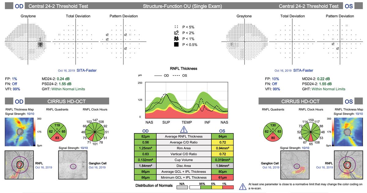 This POAG patient’s pre-treatment IOP was 24mm Hg OD and OS. OCT shows RNFL loss with a clear inferior bundle defect in the right eye. The visual field is just starting to show some abnormal points. After discussing all treatment options with the patient, he elected to have SLT to avoid the topical side effects of medical therapy and the challenges of being compliant. At nine months post-SLT OU his IOP is 17mm Hg OU.