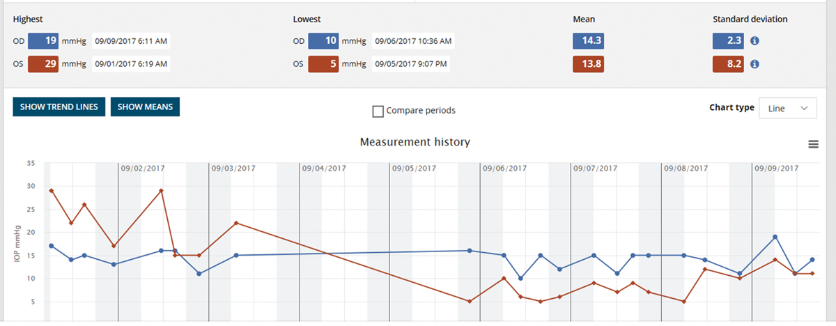 The iCare Home measurement report gives the highest and lowest IOP for each eye, as well as the day and time. It provides clinicians a quick overview of IOP measures outside of office hours.