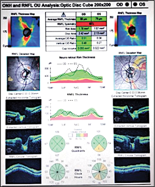 Fig. 5. OCT imaging shows no evidence of RNFL dropout OD and borderline thin RNFL superior temporal to the disc OS.