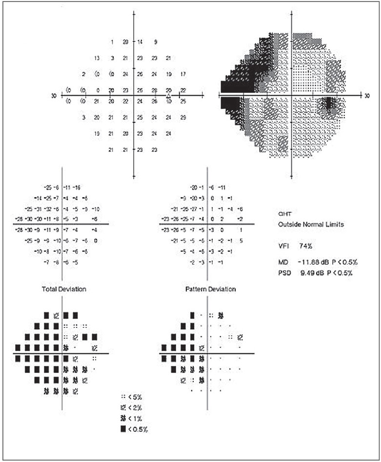 Fig. 1. This patient’s 24-2 field shows moderate visual field damage with central involvement. 