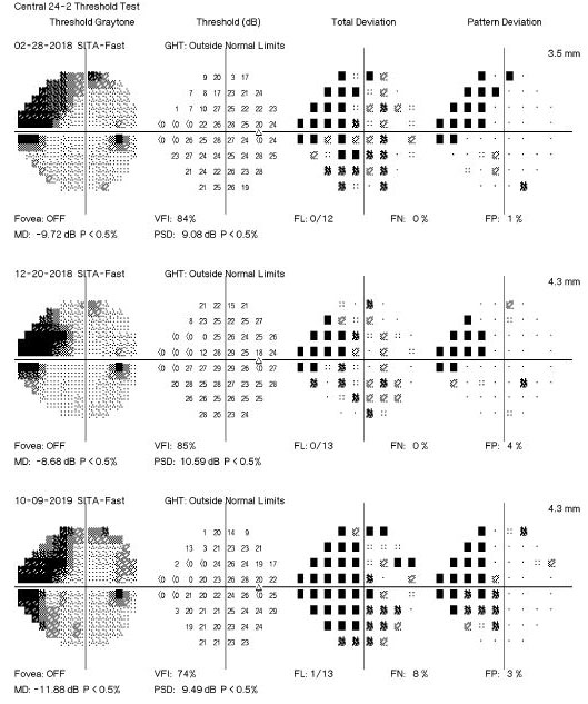 Fig. 3. This visual field readout shows event-based change, indicating visual field progression.