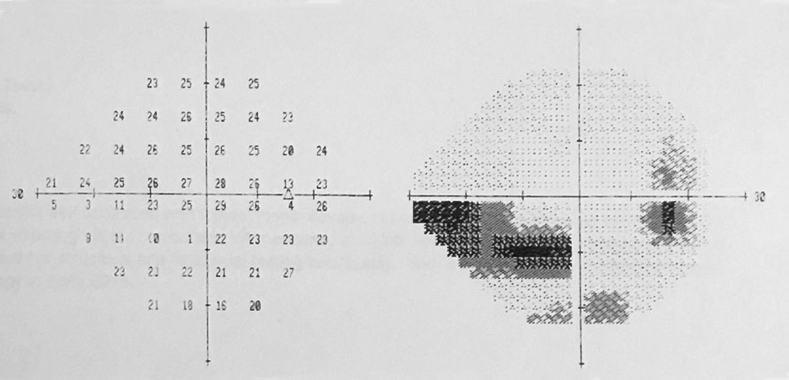 Automated perimetry yielded these field results.