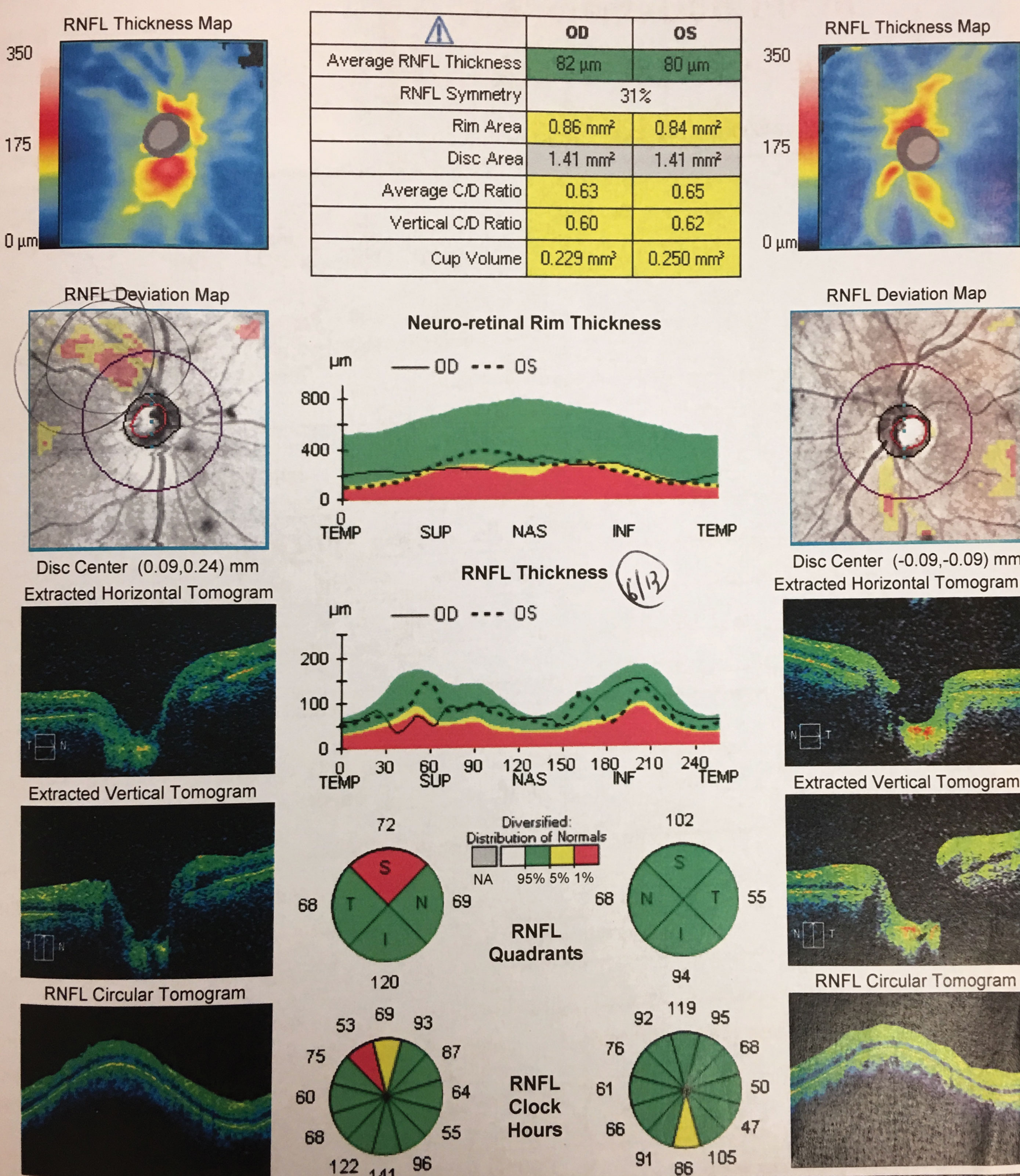 RNFL scans OS and OD.