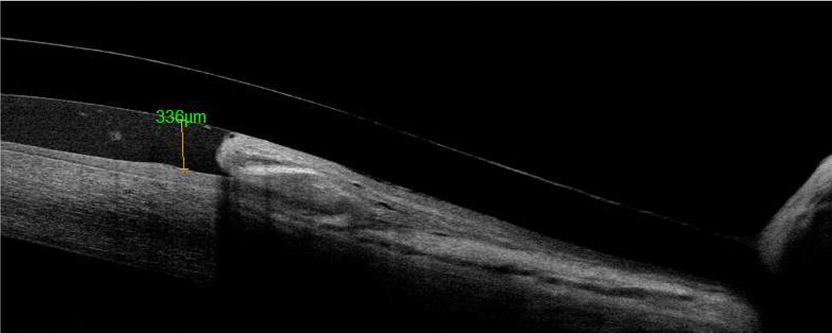 Fig. 2. Anterior segment OCT of the limbal area shows conjunctival prolapse.