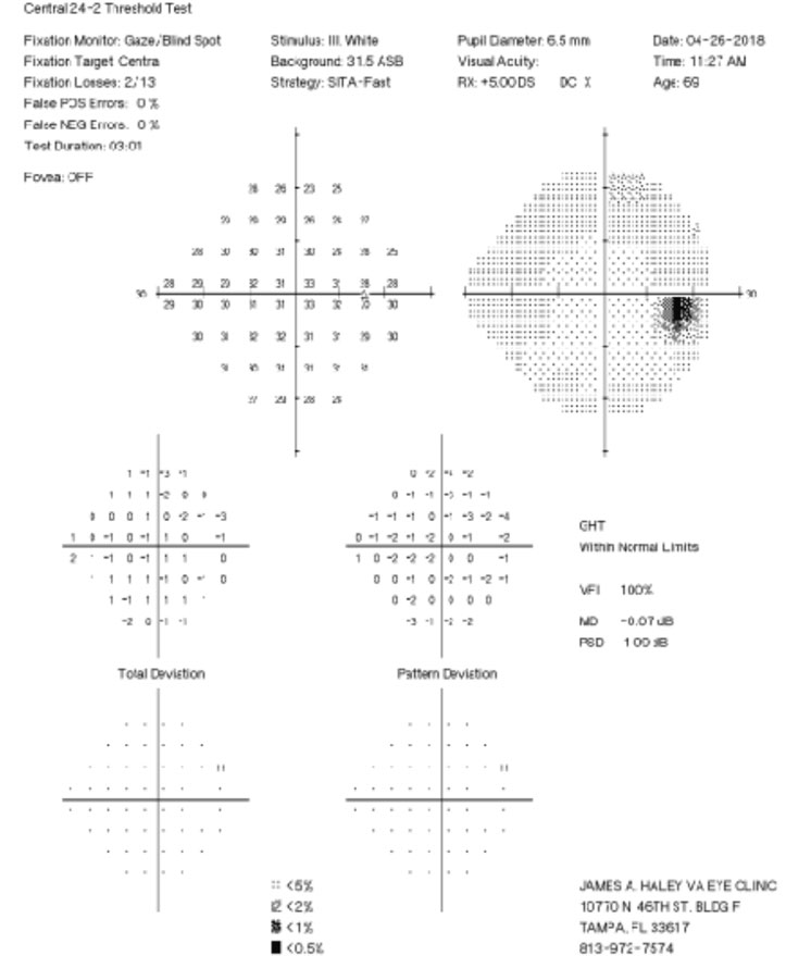 Fig. 2. His 24-2 visual fields the year prior show no glaucomatous visual field defects.