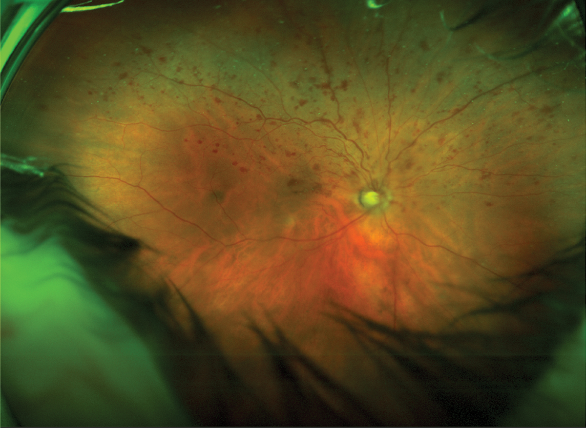 Interpretation and report of widefield imaging taken in office: Clinical findings/diagnosis: H34.8310 tributary (branch) retinal vein occlusion, right eye, with macular edema. Reliability of the test: reliable OD. Comparative data/change in condition: baseline OD. Clinical management: referral to retinal surgeon tomorrow for evaluation and anti-VEGF intravitreal injection OD.