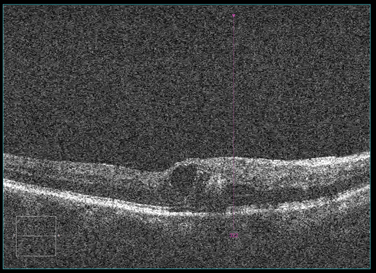 Interpretation and report of OCT performed at the surgeon’s office the next day:  Clinical findings/diagnosis: H34.8310 tributary (branch) retinal vein occlusion, right eye, with macular edema. Reliability of the test: reliable OD. Comparative data/change in condition: baseline OD. Clinical management: anti-VEGF intravitreal injection performed OD.