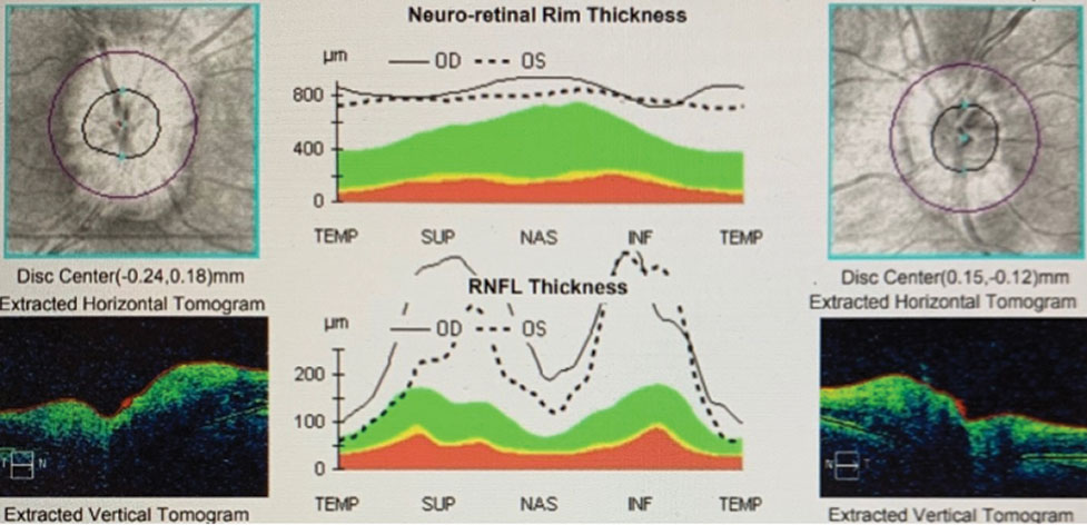 OCT shows the relative swelling of the optic nerves, OD>OS.