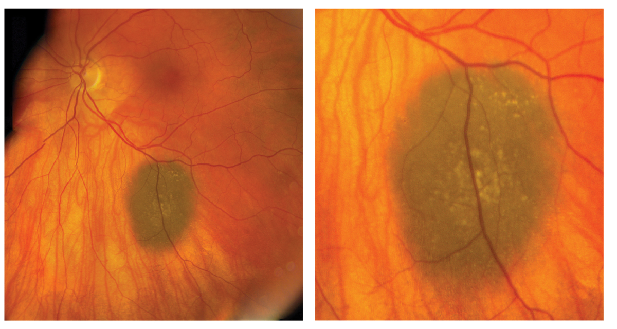 Figs. 1 and 2. These are the fundus photographs of the left eye of our patient. What do they represent?”