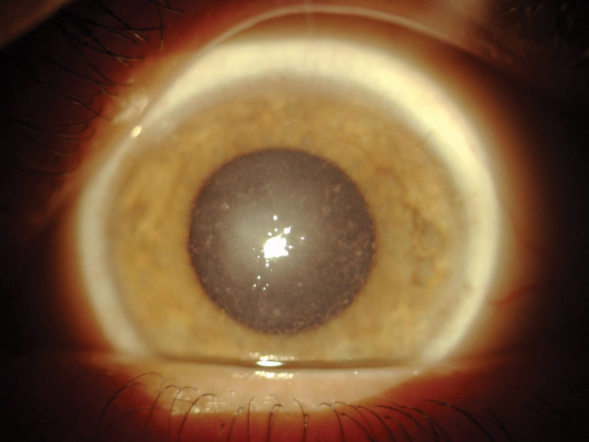 Corneal Dystrophy Congenital Stromal Hereditary Ocular Diseases | Hot ...