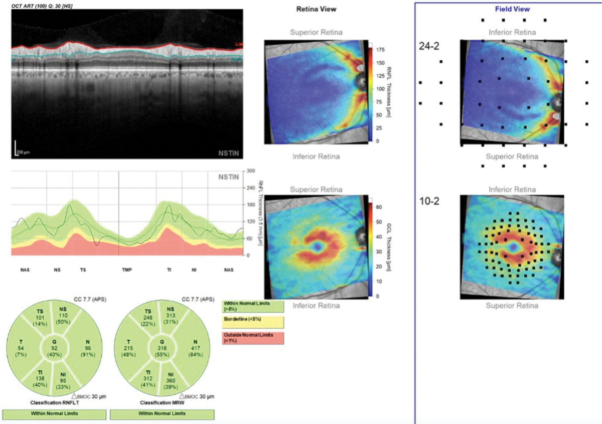 This Hood Report of a patient with a superior arcuate RNFL defect provides a comprehensive baseline that integrates RNFL, minimum rim width, GC-IPL and projected 10-2 and 24-2 VFs.