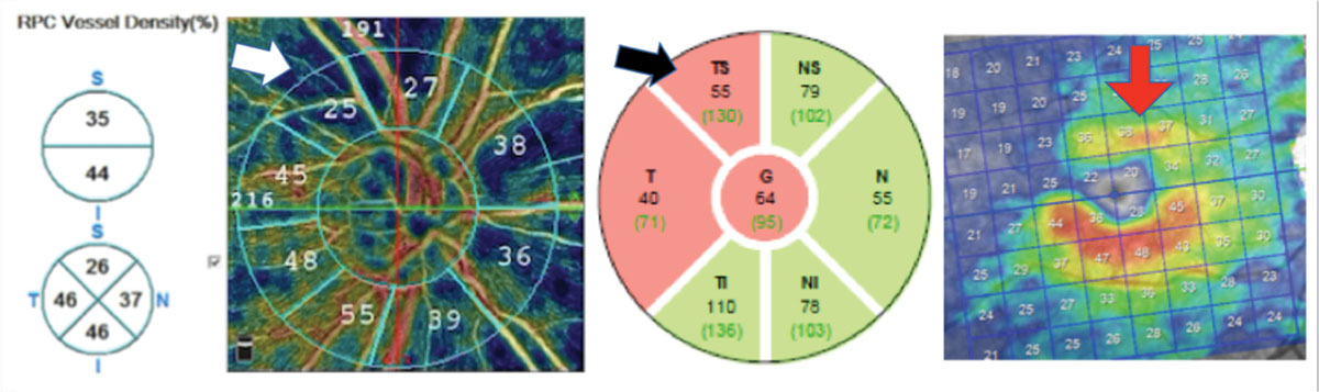 This open-angle glaucoma patient has substantial reduction in vessel density (white arrow), which correlates with a superior temporal RNFL (black arrow) and GC-IPL thinning (red arrow). Note that hotter colors indicate greater vessel density than cooler colors.