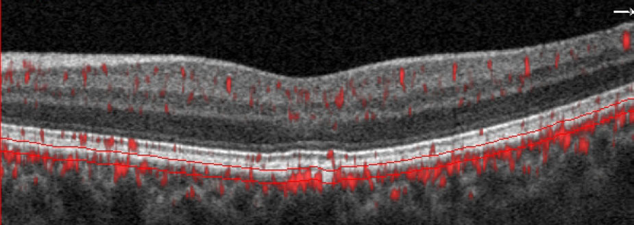 This 63-year-old African American male is a glaucoma suspect with no visible abnormality noted in the macula on fundus examination. However, the choriocapillaris slab and the B-scan with segmentation lines set at the choriocapillaris depict a non-exudative occult choroidal neovascular membrane. In this case, OCT-A identified a naïve macular lesion that was not visible clinically, allowing for timely referral and comanagement.