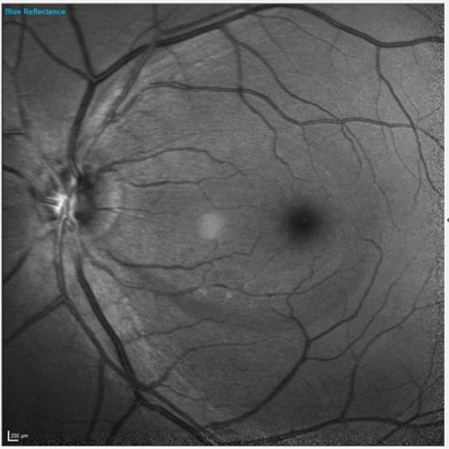 Fig. 1. Note the inferior wedge defect clearly visible in the patient’s left eye.