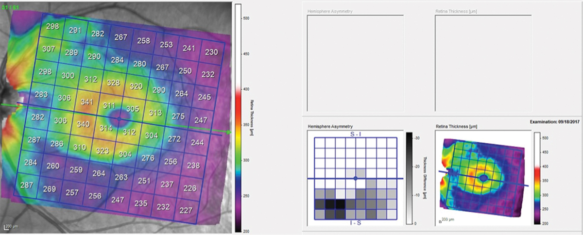 Fig. 3. Total retinal thickness in the left macula shows asymmetry between the superior and inferior hemispheres, with the inferior hemisphere thinner in the area of the wedge defect.