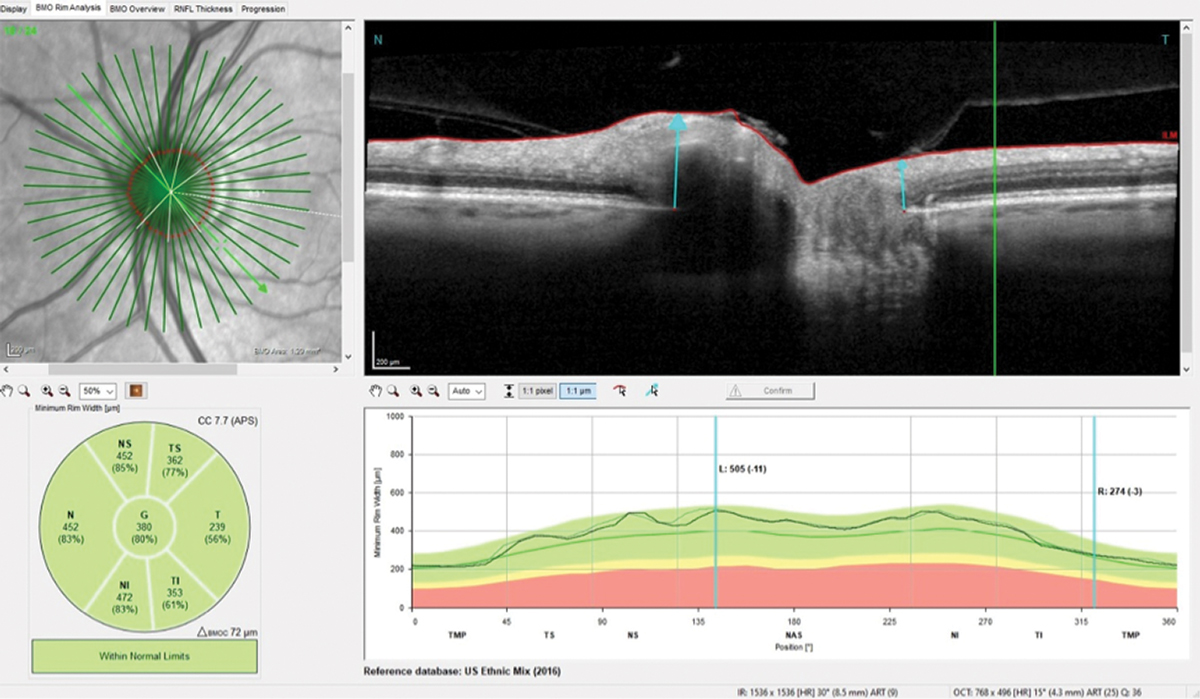 Fig. 5. The neuroretinal rim remained stable compared with baseline despite the four years the patient was lost to follow-up.