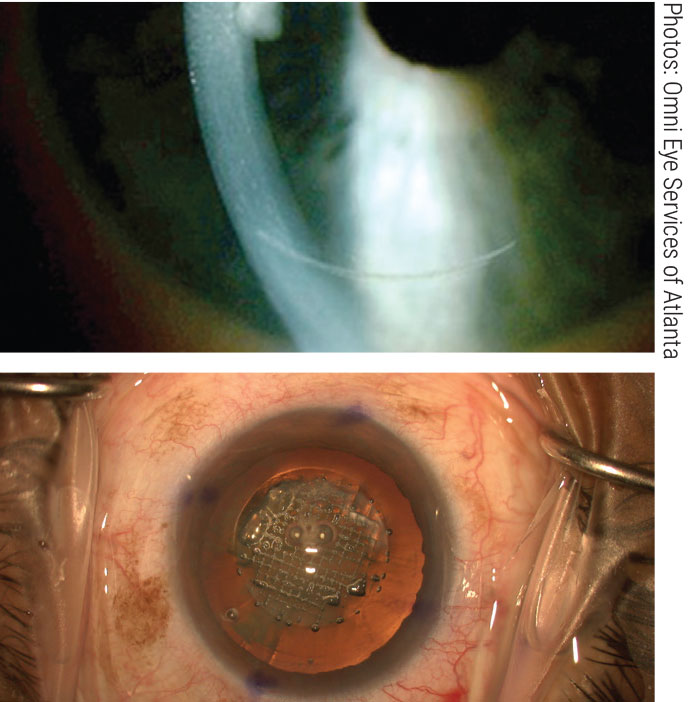 The femtosecond laser makes precise arcuate incisions (top), fragments the nucleus (bottom) and automates capsulorhexis formation.