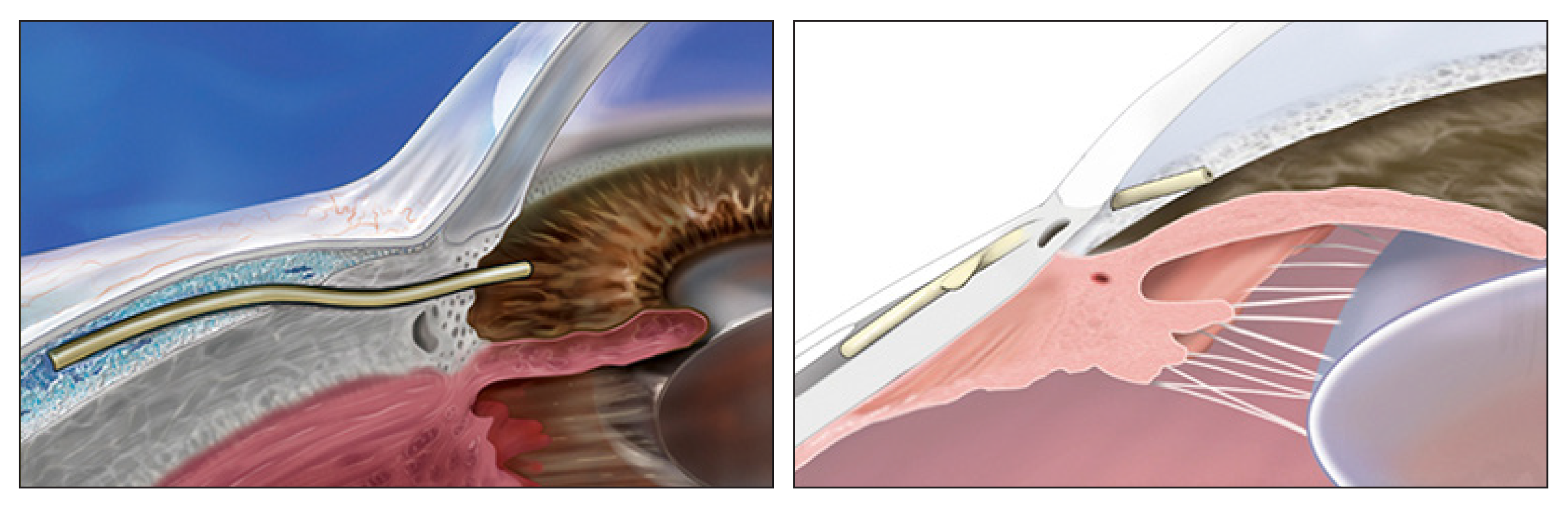 According to the researchers’ findings, the percentage of patients in 2021 who received surgery for an early stage of glaucoma was more than double the percentage of patients in 2011 (12.9% vs. 6.1%). Minimally invasive bleb-forming procedures (Xen and Preserflo) have helped fuel this shift, they noted.