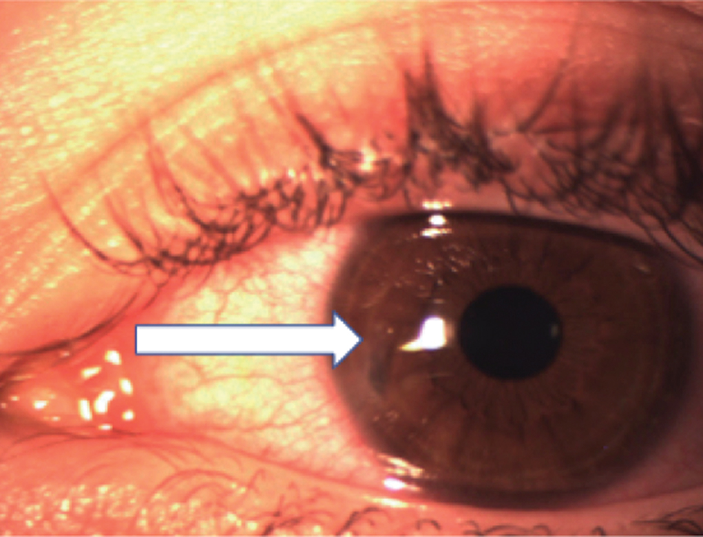 This patient was diagnosed with an open globe injury.