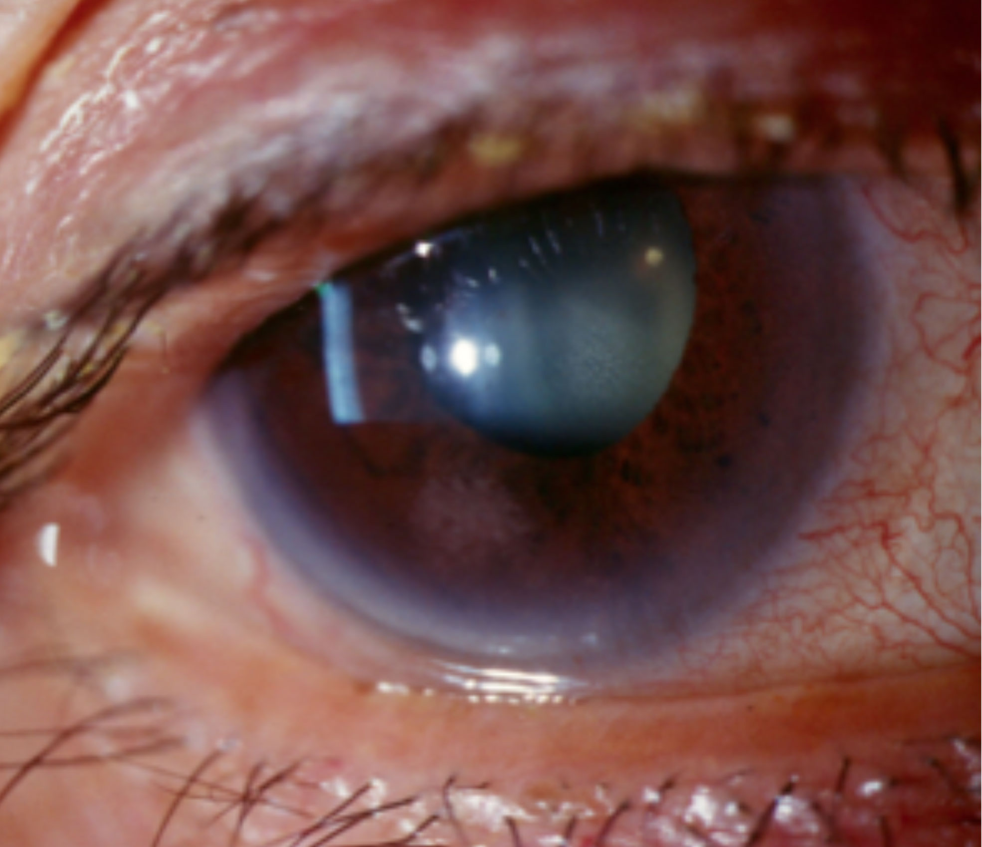 Limbal hyperemia associated with anterior uveitis.