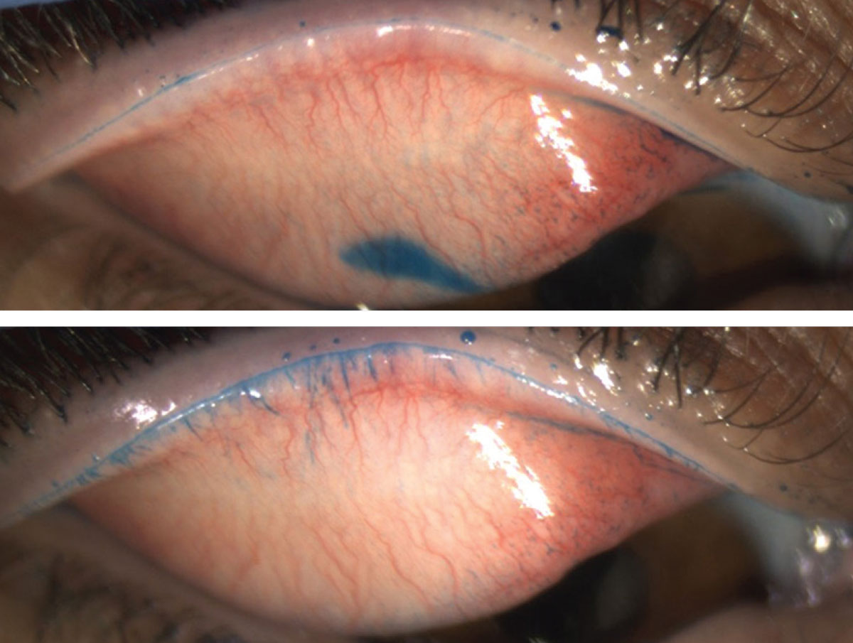 Fig. 2. The image on top only reveals the line of Marx, whereas the image underneath shows additional proximal LWE staining.