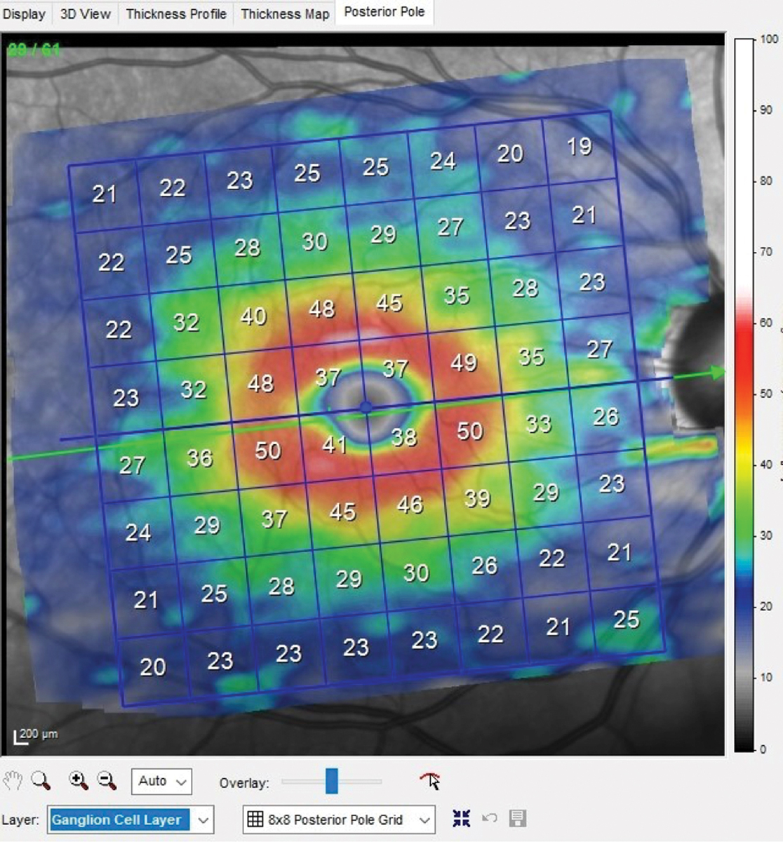 OCT of the right eye shows a relatively normal macular ganglion cell layer. Ganglion cell layer thickness averages 40μm to 45μm in the macular region, with the thickest region adjacent to the foveal avascular zone.